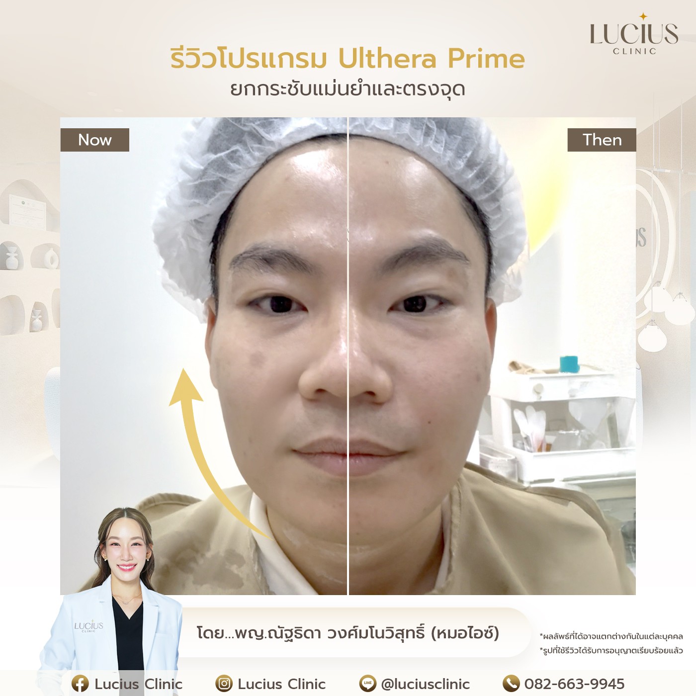 รีวิว Ulthera Prime
